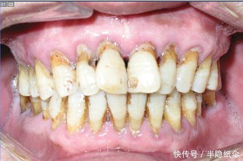 牙齿矫正后的保持器究竟要戴多久？这是一个让许多患者头疼的问题。本文将通过几个步骤详细解答。