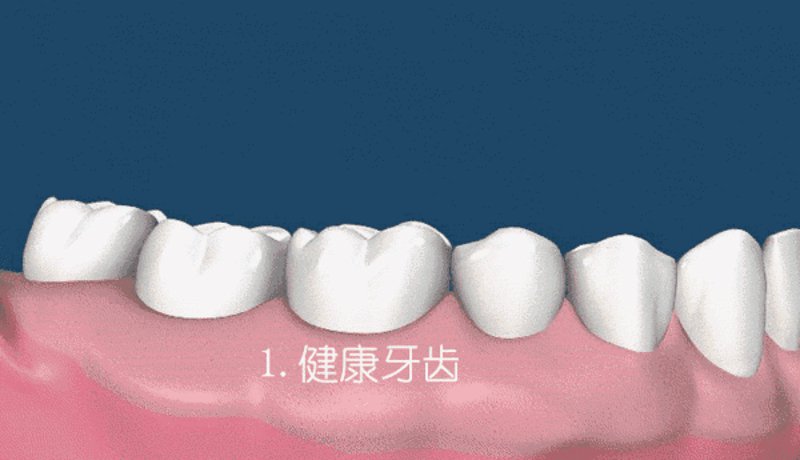 牙齿矫正后保持器要戴多久？这个问题让不少患者困扰不已。
